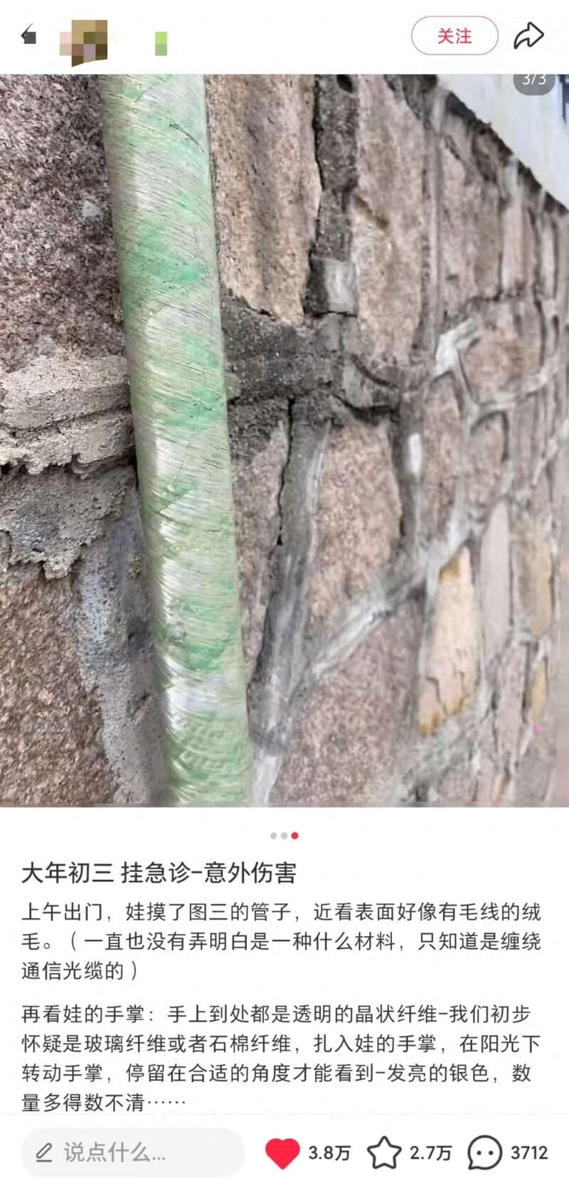 小心!小孩被玻璃纤维扎伤 医院无法全部取出