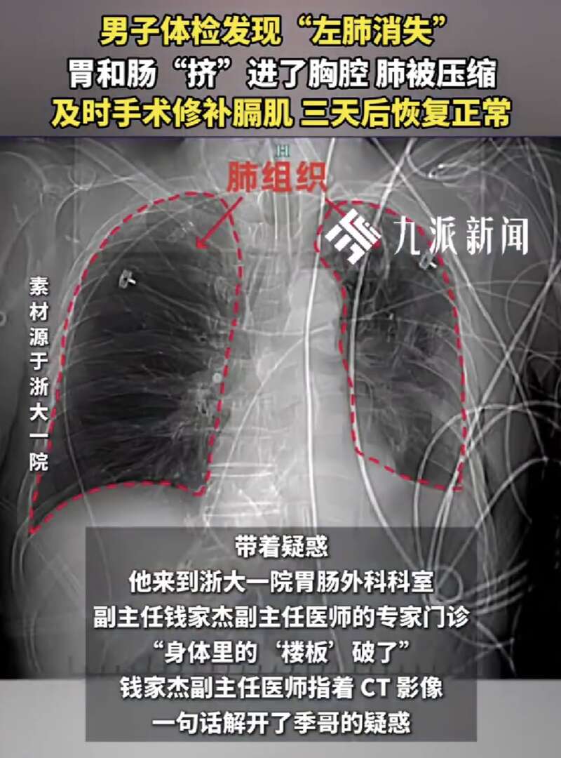 男子中奖获体检 发现左肺不见了 无明显不适