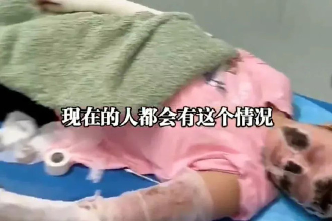 睡觉时手机放枕边充电突爆炸！女子全身7成烧烫伤