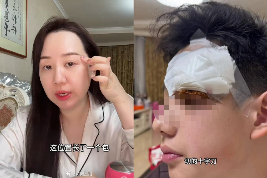 女星替13岁儿子挑痘酿祸 害缝4针自责"心如刀割"