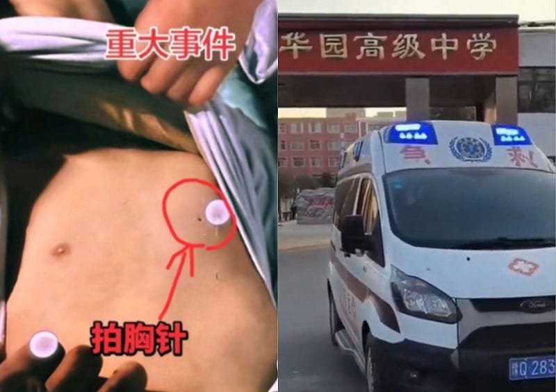 中国13岁学生猝死 左胸惊见钉子洞 网民震怒
