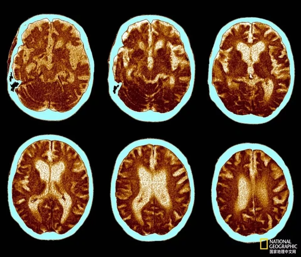 为何阿尔茨海默病人 很少得癌症？科学家惊人发现
