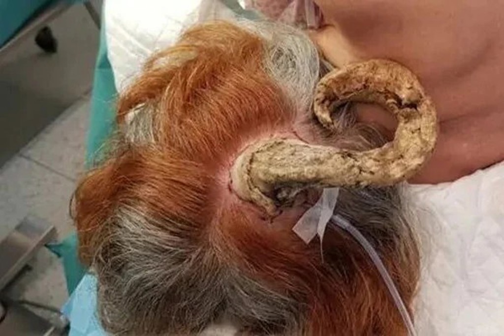 邪灵附身？ 75岁妇头长「恶魔角」 就医结果出炉